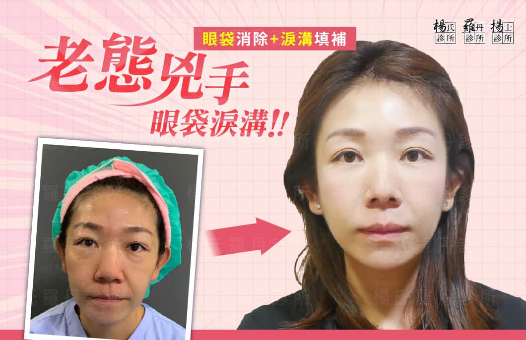 【眼袋淚溝】老態兇手~眼袋淚溝！